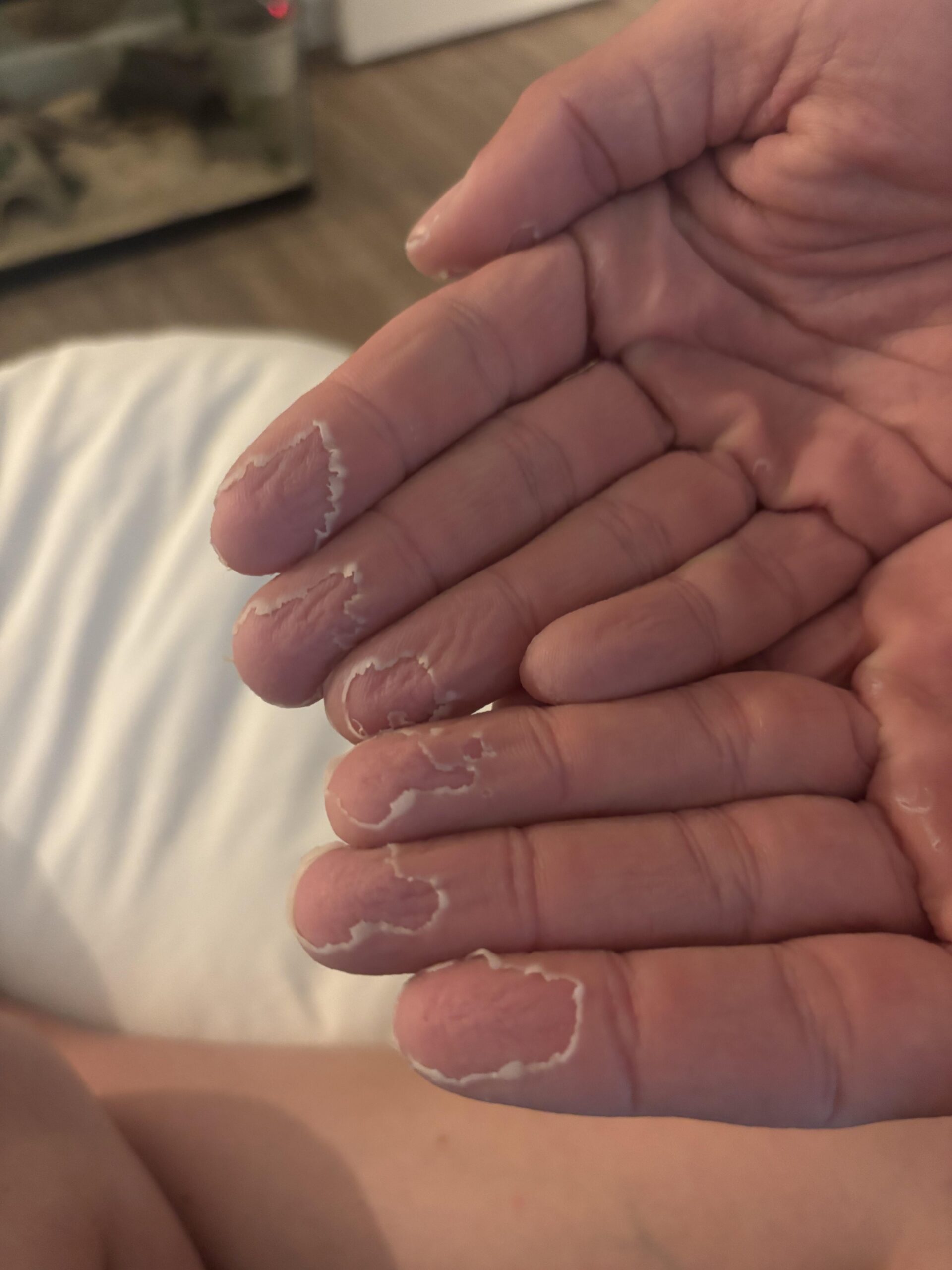 指先がボロボロ…ヤバい病気？原因と対策を徹底解説