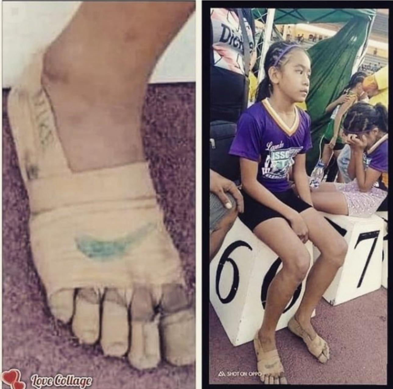 貧乏少女、テーピングで金メダル3個！奇跡の11歳