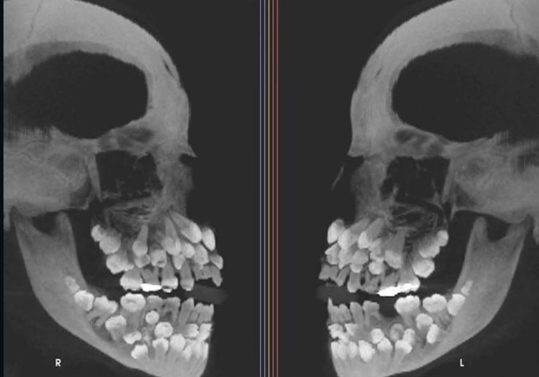 衝撃！81本歯の男！超多歯症レントゲン画像がヤバい
