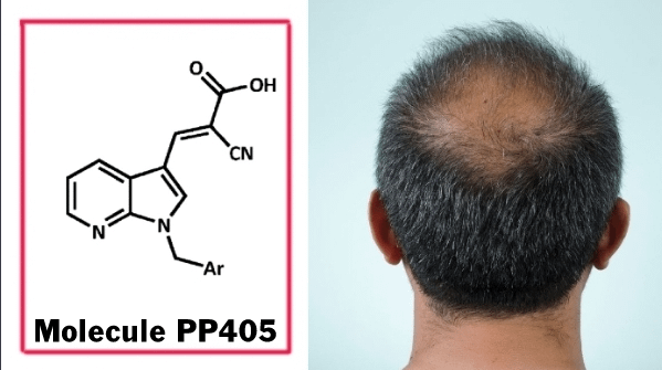 朗報！ UCLAがハゲ治療薬「PP405」開発か！？