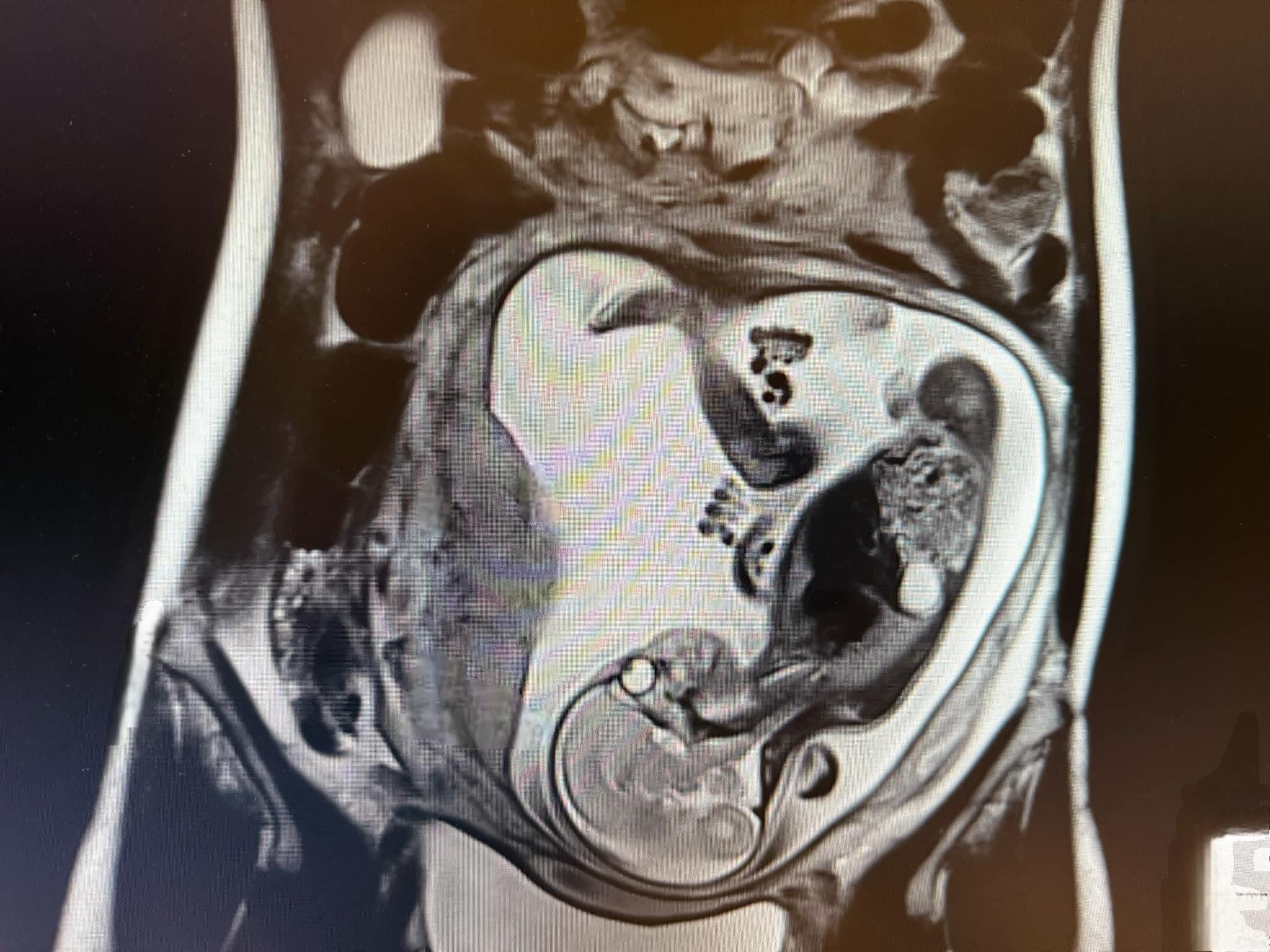 妊娠26週で腎結石！MRI検査の体験談