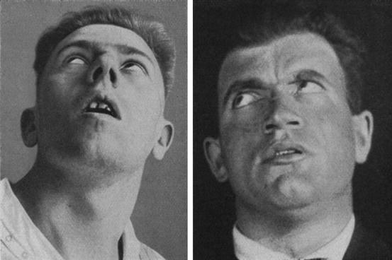 【戦慄】1915年～1926年、原因不明の奇病「嗜眠性脳炎」世界で大流行…50万人が死亡or全身麻痺で生き地獄へ…そして忽然と消滅…
