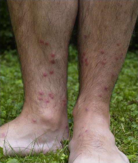【悲報】川や湖で泳ぐだけで感染する謎の病がヤバすぎると話題