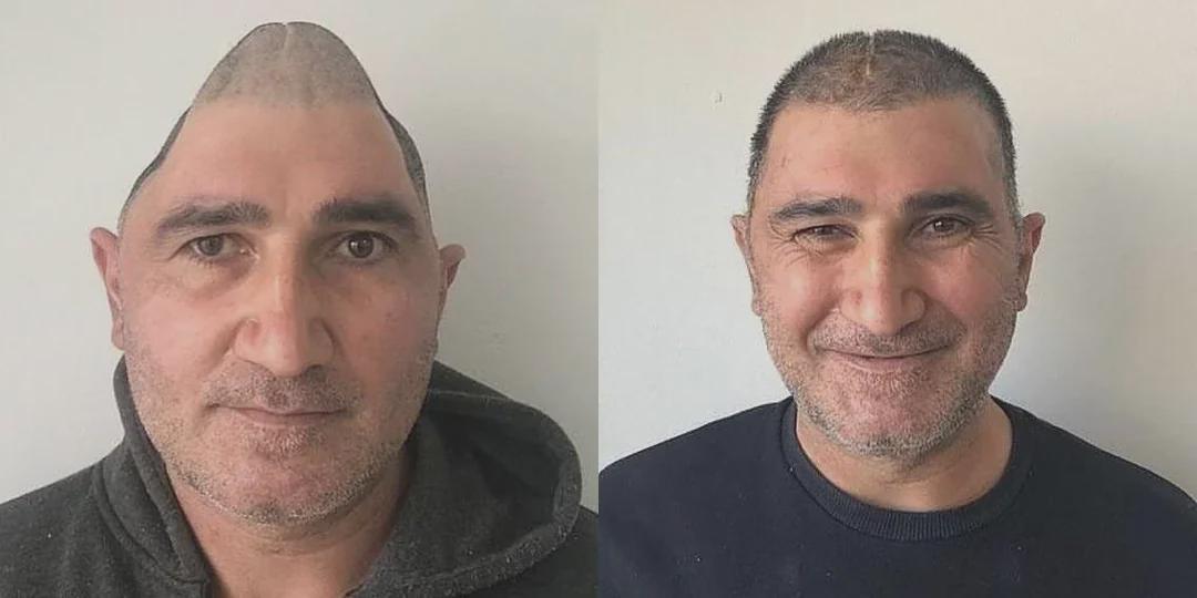 家の窓から転落→頭蓋骨83%失った男、3Dプリンタとチタンで復活