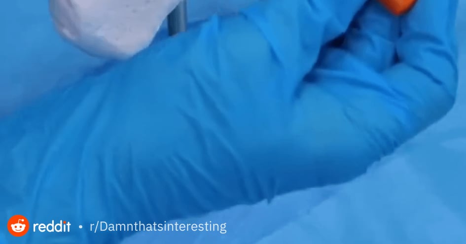 【悲報】アキレス腱断裂、手術の全貌がグロすぎると話題に