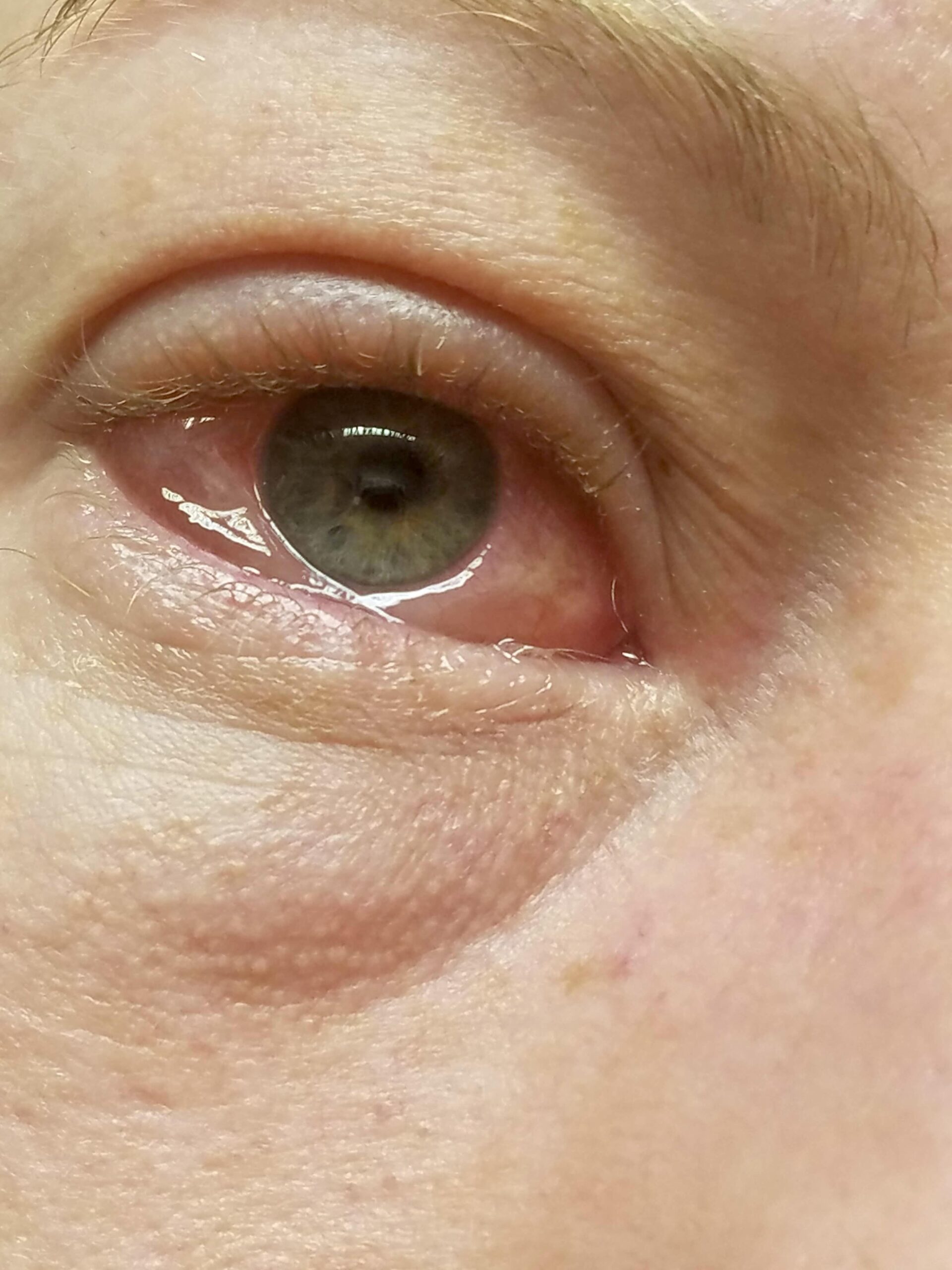 白目が虹彩を覆うほど腫れ上がった件について