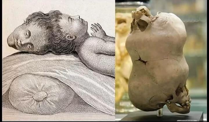 1783年生まれの少年、二つの頭を持つ。もう片方の頭は完全に機能し、囁き声が聞こえたという…